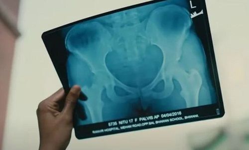 Nitu Ghanghas’s X-ray copy, showing her pelvic injury