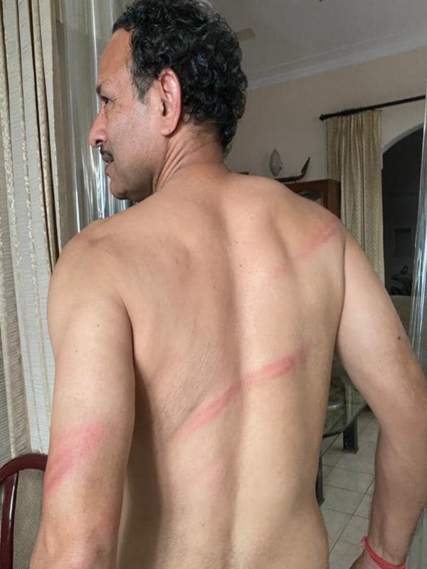 A picture of Anurag Bhadouria showing marks of lathi charge during Hathras case protest