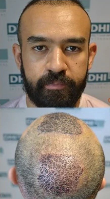Dhruv Barman hair transplant